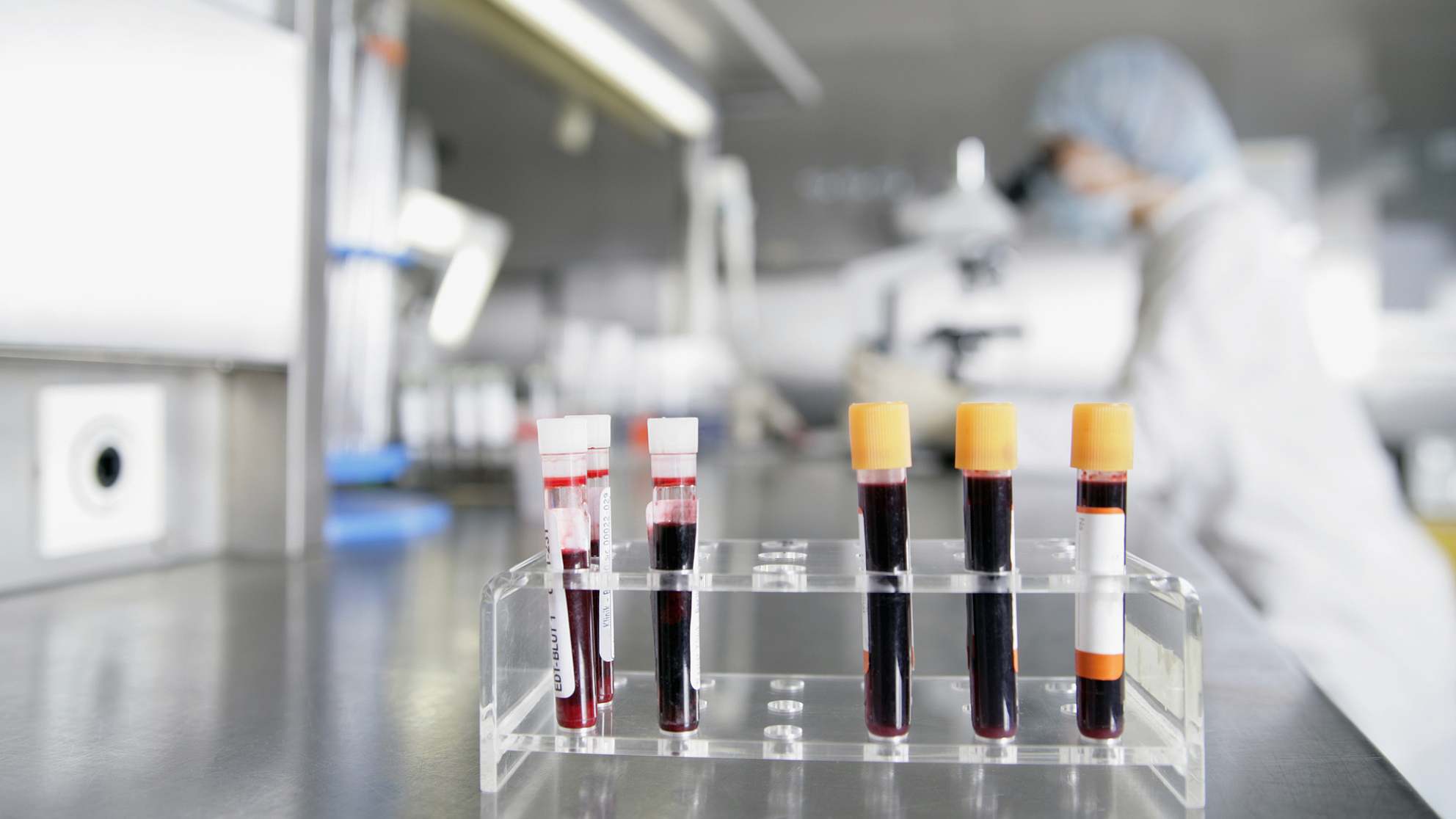 Генетический тест крови. Лабораторные исследования крови. Лабораторные методы исследования крови. Лабораторная диагностика ра. Лабораторные исследования при онкологии.