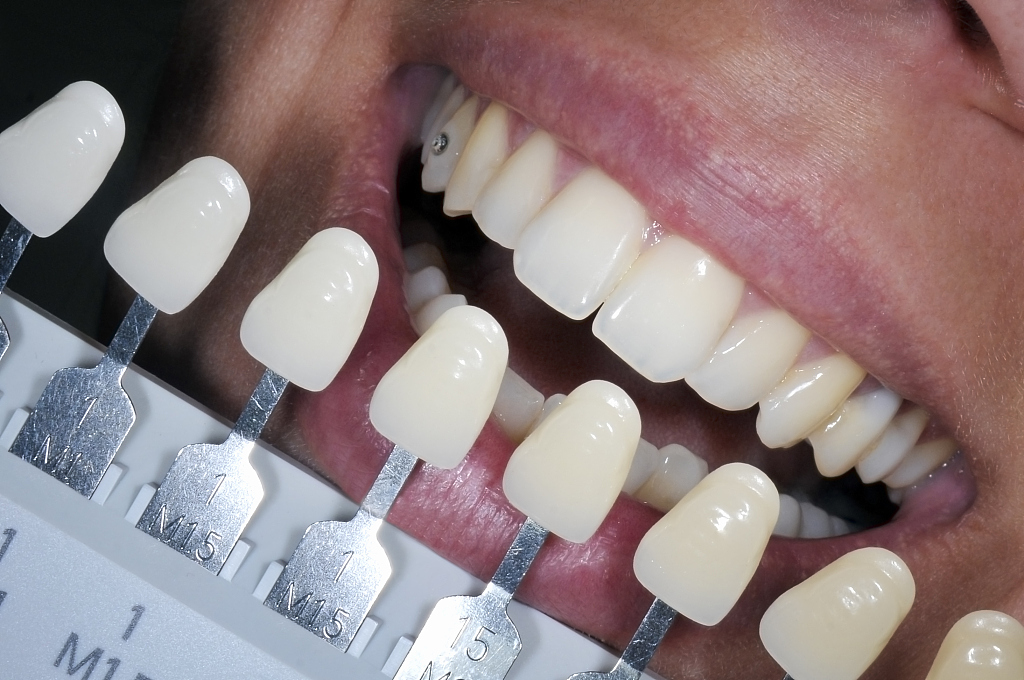 Teeth Bleaching Treatment /CFP