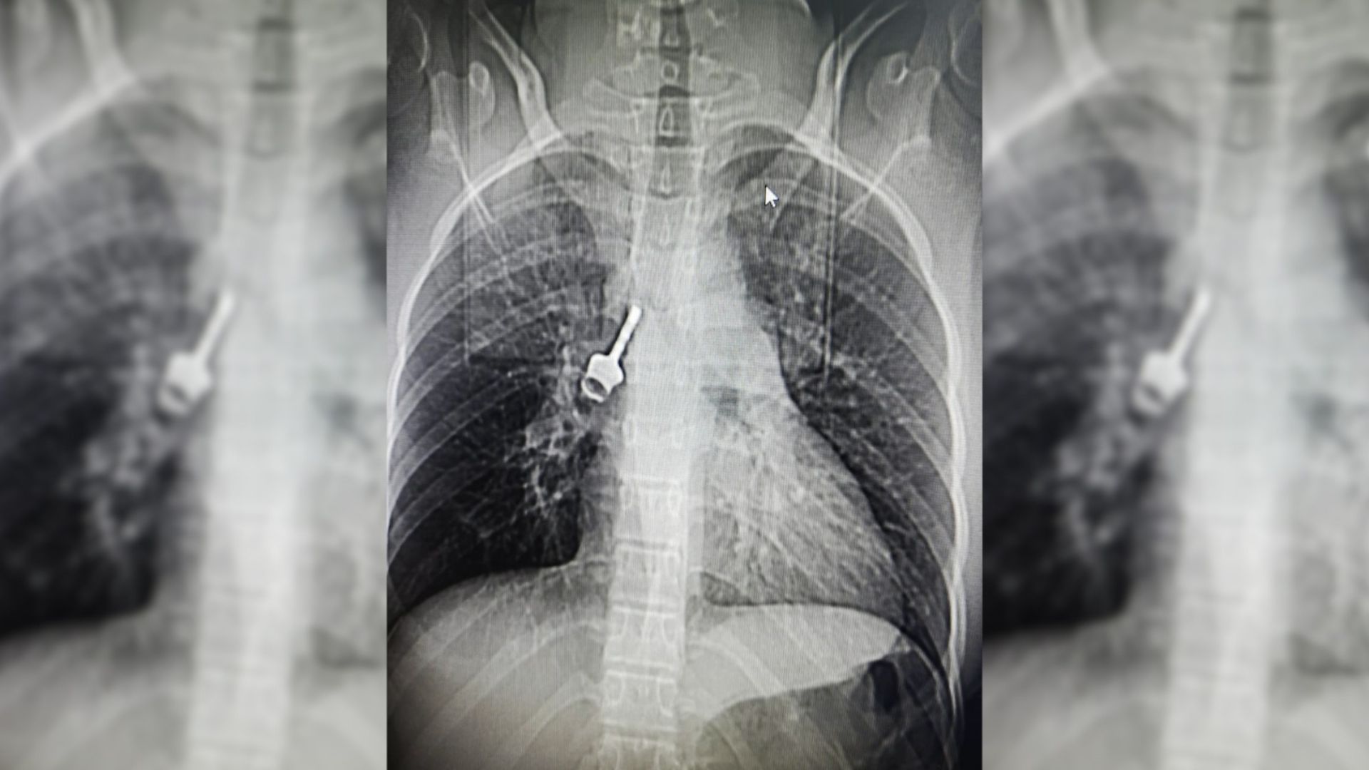 This x-ray shows a key inside the lungs of a 12-year-old girl in Kinshasa, who would have died without Dr. Gonzalez Rivas's surgery. /Handout