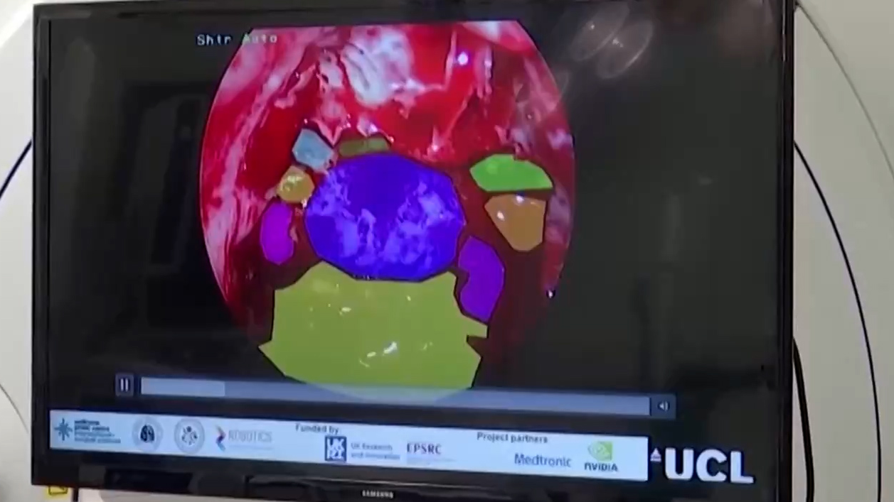 Live video feed of the patients brain color-coded by the AI tool. /Reuters